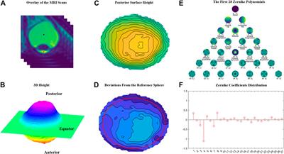Quantifying the morphology of eyeballs with posterior staphyloma with Zernike polynomials